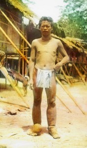Indigenous man with disease, India, ca. 1920