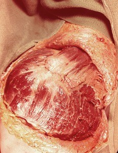 Natural color photograph of dissection of the right shoulder, anterolateral view, showing the superficial muscle structure of the shoulder