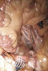 Natural color photograph of dissection of the pelvic cavity, anterior view, showing the mesentery and vessels of the pelvic cavity