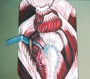 Illustration of dissection-exposed right hip joint capsule, with gluteus maximus muscle divided and retracted and both gluteus medius and gluteus minimus muscles cut from their insertions and reflected upward; sciatic nerve also exposed instrumentally
