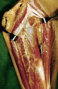 Natural color photograph of dissection of the forearm