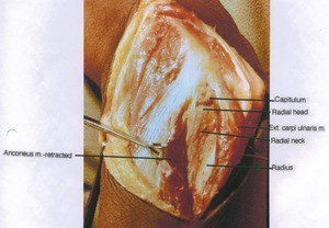 Natural color photograph of left elbow, lateral view, showing muscles and bones with the anconeus muscle retracted