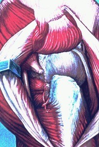 Illustration of surgical exposure of right hip joint's capsule, with gluteus medius and gluteus minimus muscles reflected and piriformis m. detached from greater trochanter, lateral view