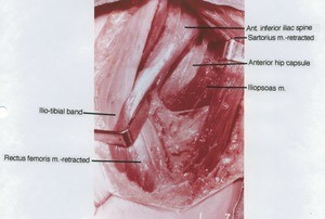 Natural color photograph of dissection of right anterior hip capsule, anterior view, with the IT band, rectus femoris, and sartorius muscles retracted