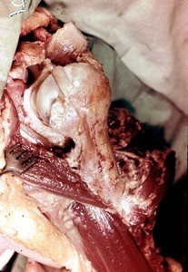 Natural color photograph of dissection of the left shoulder, anterolateral view, with the glenohumeral joint capsule opened to expose the tendon of the long head of the biceps brachii muscle