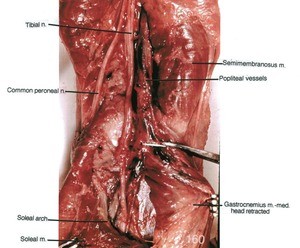 Natural color photograph of left knee, posterior view, showing muscles, popliteal vessels and the course of the tibial nerve to the soleus arch