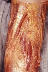 Natural color photograph of dissection of the right thigh, anteromedial view, showing muscles and tendons