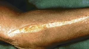 Natural color photograph of dissection of the right forearm, posterior view, initial incision