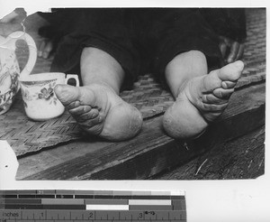 Bound feet uncovered in Dalian, China, 1927