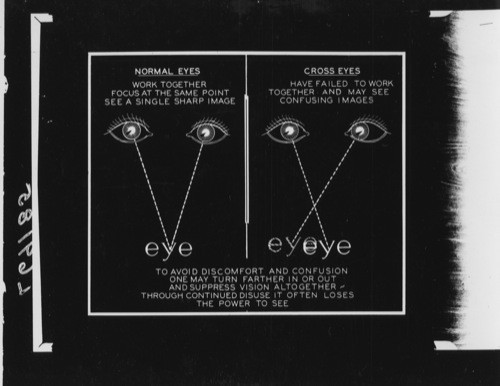 HEALTH UNIT - Special Senses. Set #8, L69185 - Why cross-eyed Person Loses Sight of One Eye, if Defect is Uncorrected