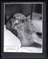 Copy of grand jury exhibit photograph of Darby Day Jr.'s facial acid burns, Los Angeles, 1925