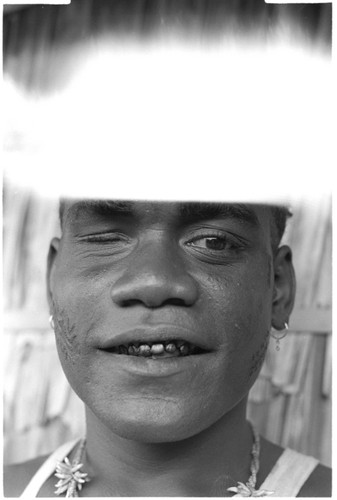 Seda, eldest son of Folofo'u and Boori'au, of Uka'oi, with swollen eye