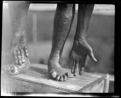 Hands and feet, damaged by leprosy