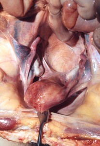 Natural color photograph of dissection of the pelvic cavity, superior view, with uterus and fallopian tubes reflected to expose the rectouterine pouch (pouch of Douglas)