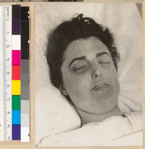 Virginia Rappe's face, probably at morgue