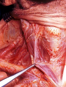 Natural color photograph of dissection of the neck, anterior view, with the right sternalcleidomastoid m. retracted