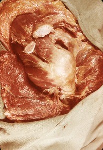 Natural color photograph of dissection of the right shoulder, superolateral view, with the acromion and clavicle cut and deltoid muscle reflected to expose the muscles of the rotator cuff