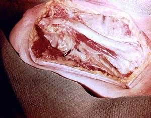 Natural color photograph of dissection of the thoracic wall, anterior view, showing the right clavicle and associated structures