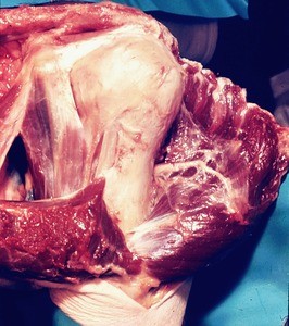 Natural color photograph of dissection of the left shoulder, anterior view, with the deltoid muscle retracted to expose the head and surgical neck of the humerus