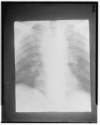 X-ray of bridge diver Ray Woods