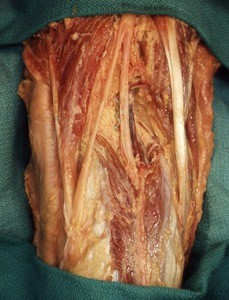 Natural color photograph of dissection of the left popliteal fossa showing the sciatic nerve branching into the tibial and common fibular nerves