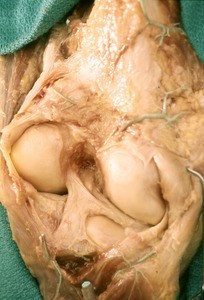 Natural color photograph of dissection of the popliteal fossa, showing the posterior cruciate ligament, the anterior cruciate ligament, and portions of the meniscus