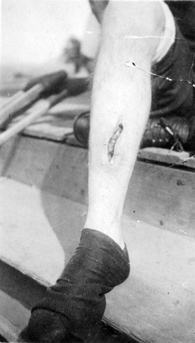 Earl J. Davis Shows Injured Leg After Wagon Wreck, Woodlake, Calif., 1920s