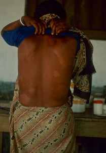 Diasserie, Bangladesh 1990: "Spedalskhed - den gamle svøbe" - Nr. 02: Spedalsk kvinde med pletter. Disse lyse pletter er de typiske symptomer på spedalskhed, og de tegn vi alle forbinder med sygdommen. Antallet af pletter og andre symptomer er afhængig af patientens egen modstandskraft imod sygdommen. Faktisk er slet ikke alle modtagelige, kun 5-10 % af en befolkning har så nedsat en modstandskraft, at de bliver smittet. Men da der ikke findes metoder, som kan klarlægge det, må alle i praksis betragtes som værende i risiko