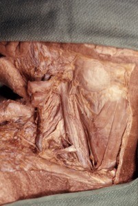 Natural color photograph of dissection of the right side of the neck, lateral view, with the carotid sheath opened to expose the right internal jugular vein and right common carotid artery