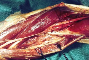 Natural color photograph of dissection of the left cubital fossa, anterior view, with the median nerve tied
