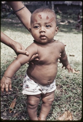 Infant with betel nut paste dabbed on face