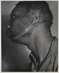 Norman Lankford, assault victim at the Villa Fonte's nightclub, Petaluma, California, May 1952