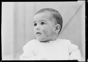 Baby with eczema, Southern California, 1932