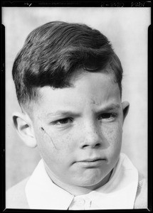Boy's scar, Southern California, 1934