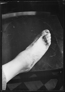 Man's foot, Dr. Jacobson's patient, Southern California, 1933