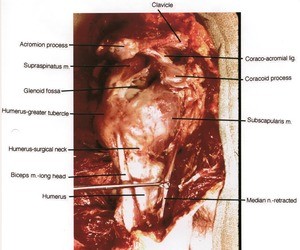 Natural color photograph of dissection of the right shoulder, lateral view, showing bone structure, muscles, and median nerve (retracted)