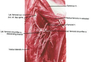 Natural color photograph of dissection of the right thigh, anterior view, showing branches of the femoral artery