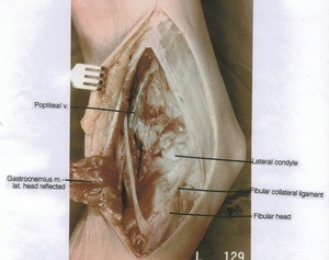 Natural color photograph of right knee, lateral view, showing muscles, vein, ligament and bone with the lateral head of gastrocnemius reflected