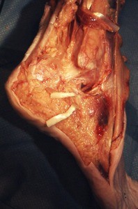 Natural color photograph of dissection of the right ankle, lateral view, showing tendons and musculature