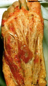 Natural color photograph of dissection of the plantar surface of the right foot