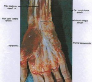 Natural color photograph of dissection of right wrist and hand, palmar surface, showing tendons and muscles