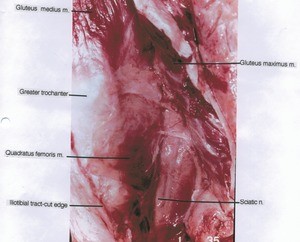 Natural color photograph of dissection of muscles of the left gluteal region, posterior view, with the gluteus maximus muscle cut and reflected