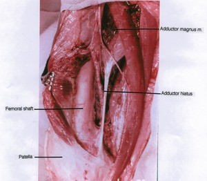 Natural color photograph of right thigh, anterior view, showing bones, muscle and the Adductor hiatus