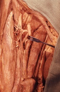 Natural color photograph of dissection of the right femoral triangle, showing the femoral vessels and femoral nerve