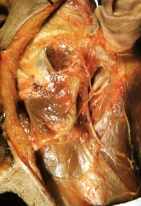 Natural color photograph of dissection of the face, left lateral view, showing the branches of the facial nerve after it has exited the stylomastoid foramen