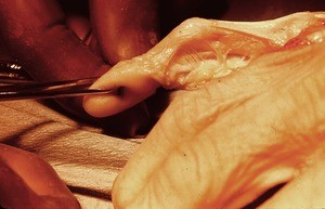 Natural color photograph of dissection of the right hand, lateral view, emphasizing the fifth digit