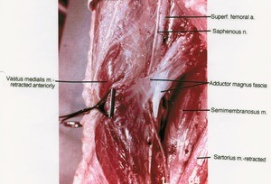 Natural color photograph of right thigh, anterior view, showing muscles, artery, nerve and adductor magnus fascia with the vastus medialis muscle retracted