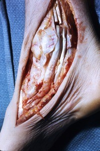 Natural color photograph of dissection of the right ankle, medial view, with the tibialis posterior t. and the flexor digitorum longus t. cut