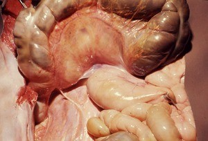 Natural color photograph of dissection of the abdomen, anterior view, with the transverse colon reflected superiorly exposing the transverse mesocolon