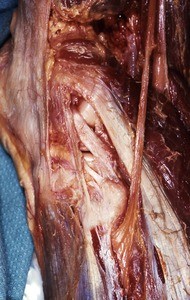 Natural color photograph of dissection of the left knee, lateral view, showing the common fibular nerve as it passes inferior to the fibular head